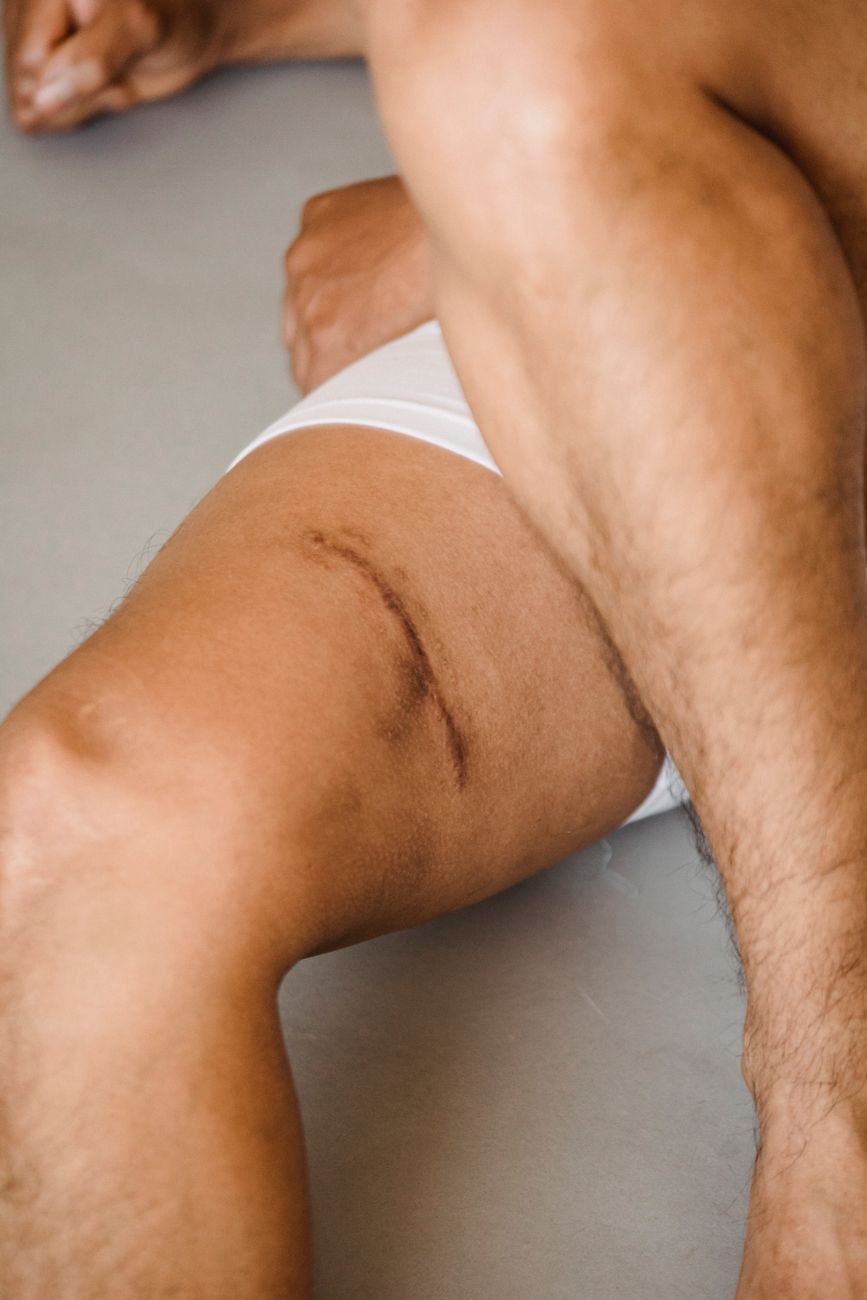 crop man in underpants with scar on thigh
